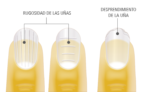 uñas dañadas